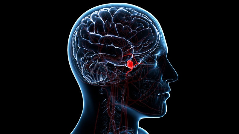 Featured image for "Early DAPT Within 72 Hours Shows Promise for Improved Stroke Outcomes"