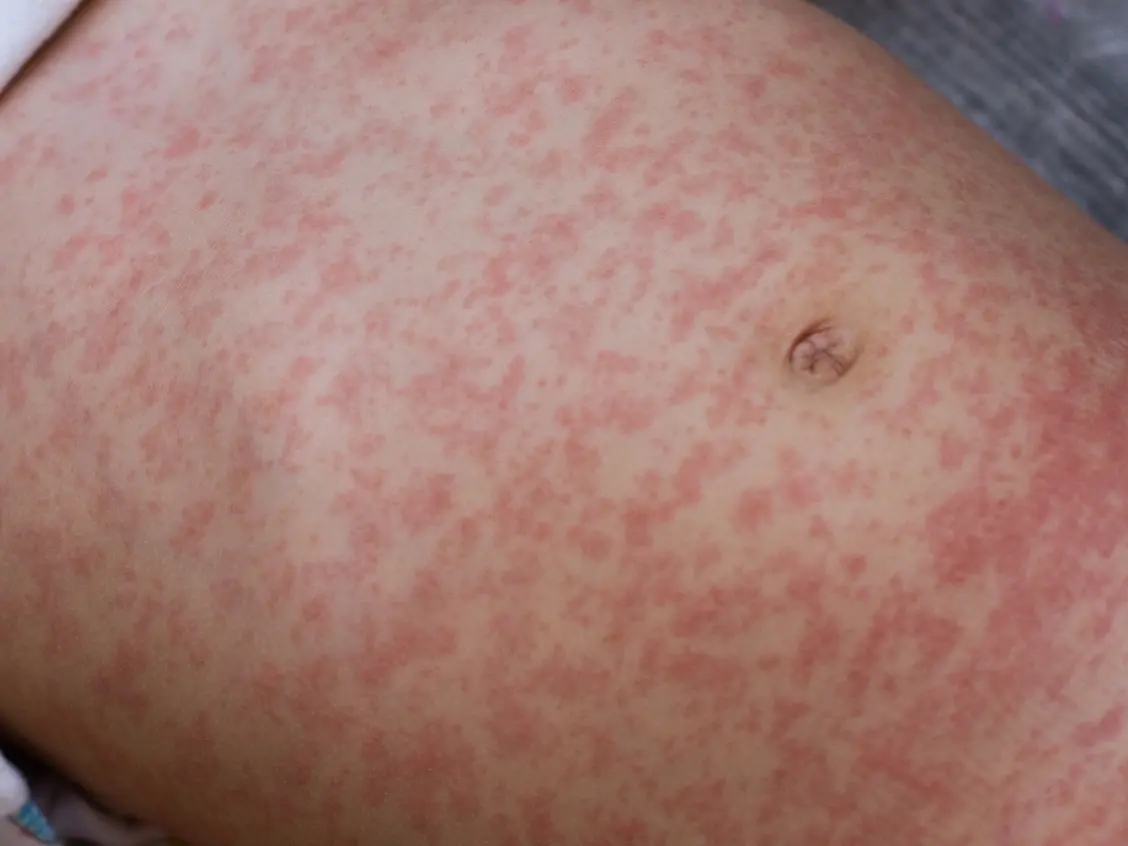 Featured image for Second Measles Case Confirmed in Suburban Cook County