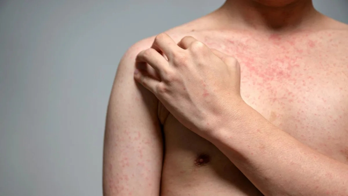 Featured image for "Training a New Generation of Doctors to Identify Measles Amid Rising Cases"