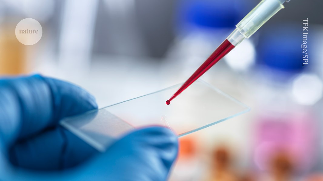 Featured image for Scientists develop first accurate blood test for chronic fatigue syndrome