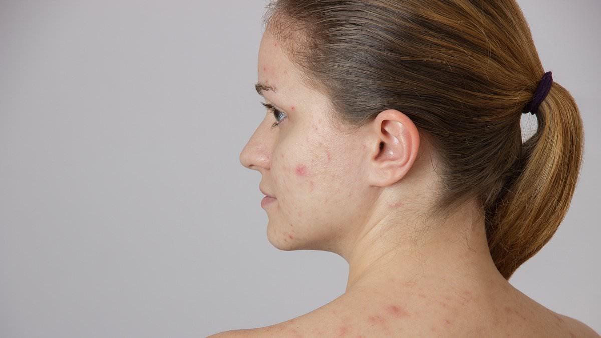 Featured image for "Study reveals 'acne prejudice' impacts hiring, dating, and friendships"