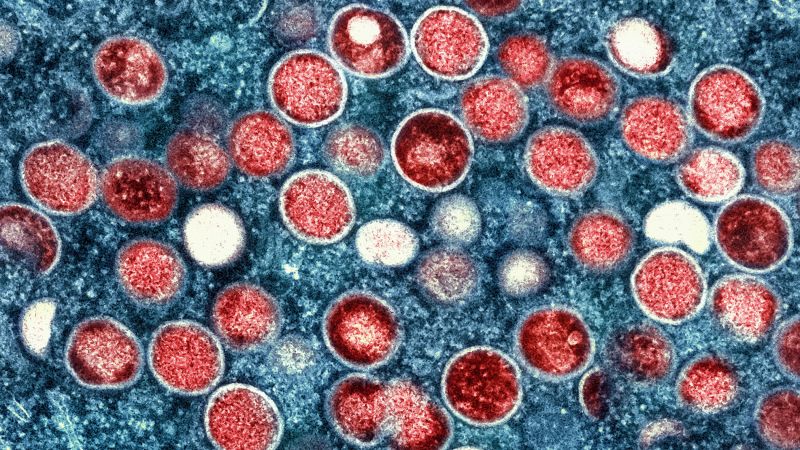 California Confirms First U.S. Case of New Severe Mpox Strain