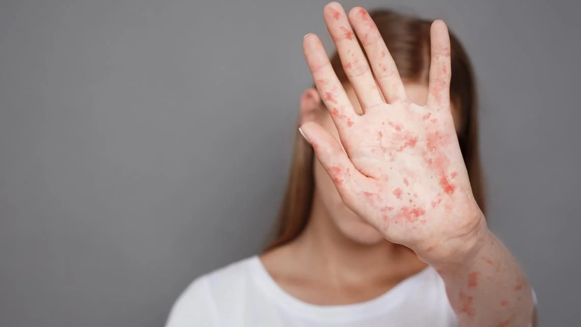 Mecklenburg Public Health Flags Measles Exposure at Two Charlotte Sites