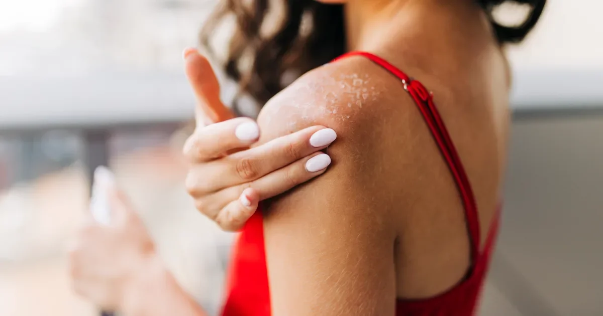 Sunburn SOS: Essential Steps for Immediate Relief and Recovery