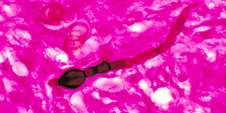 Construction in Wisconsin linked to deadly fungal outbreak.