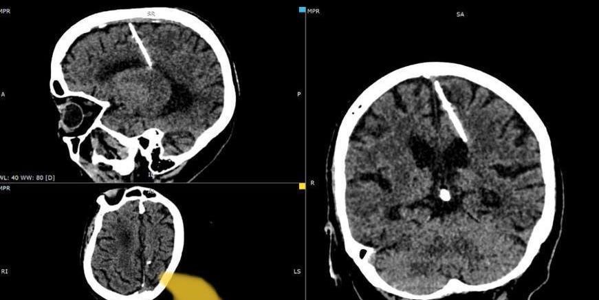 Featured image for "Unbelievable: Russian Woman Survives 80 Years with Needle Lodged in Brain"