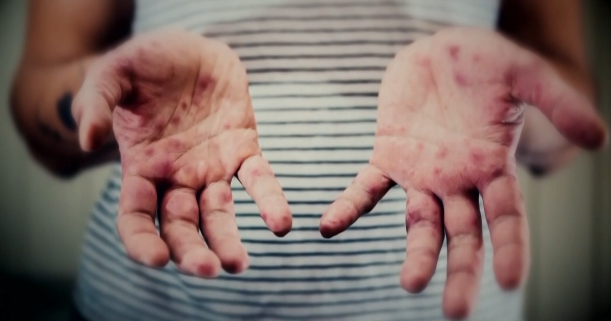 North Carolina Reports First Measles Case of 2025