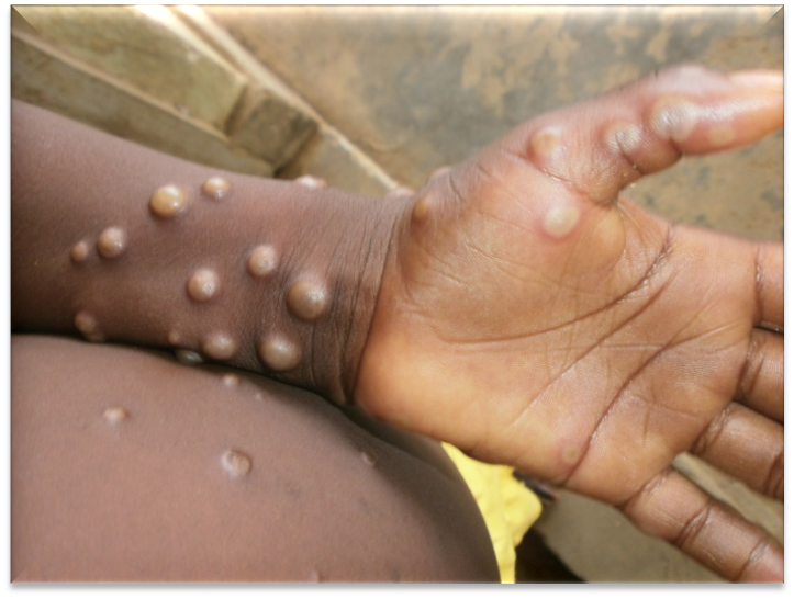 Featured image for Barbados Reports Three New Mpox Cases