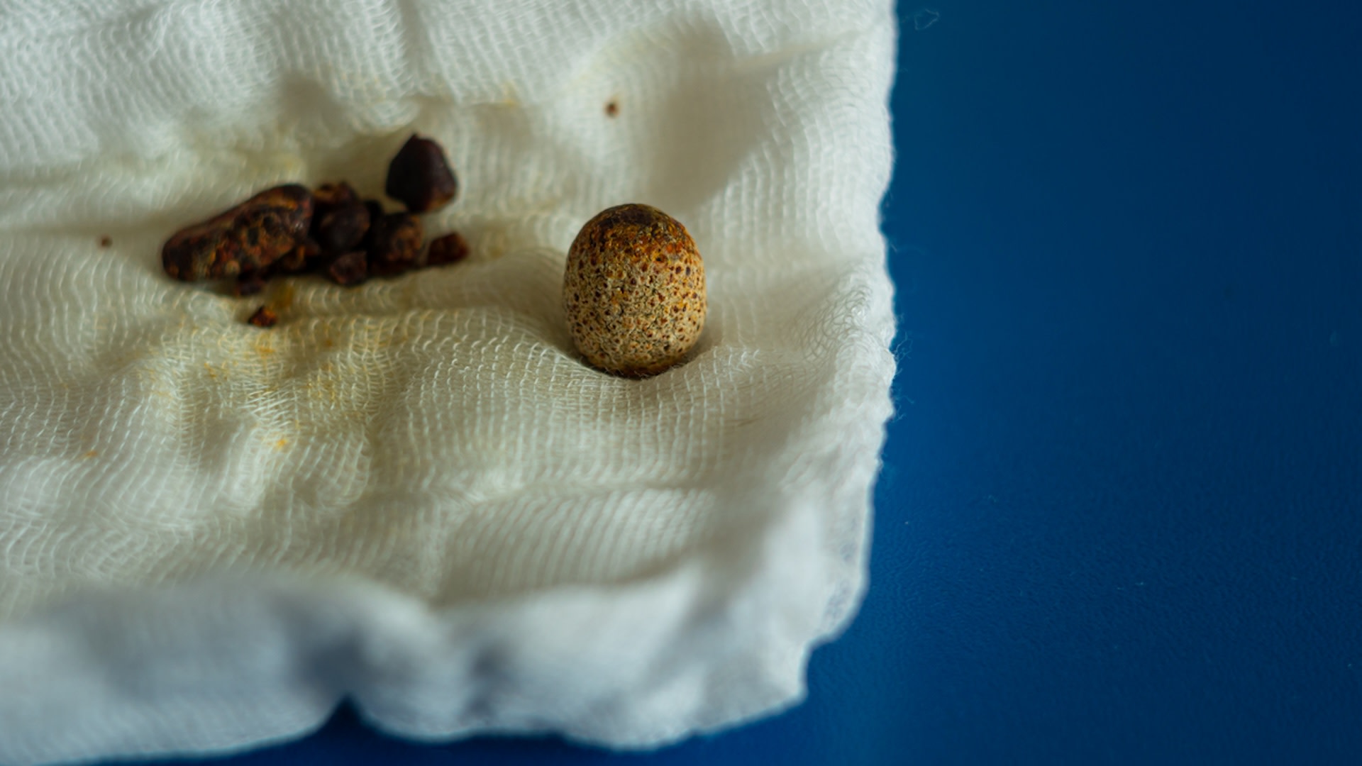 Featured image for Microplastics Detected in Human Gallstones and Brains: A Disturbing Discovery