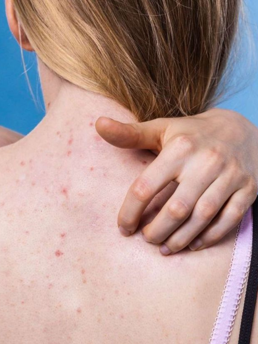 Featured image for Top 8 Skincare Tips for Back Acne