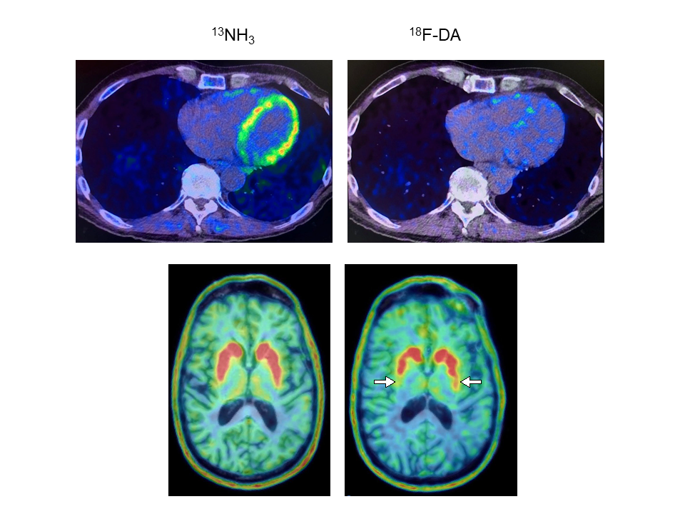 Featured image for Advancements in Predicting Parkinson's Disease and Lewy Body Dementia