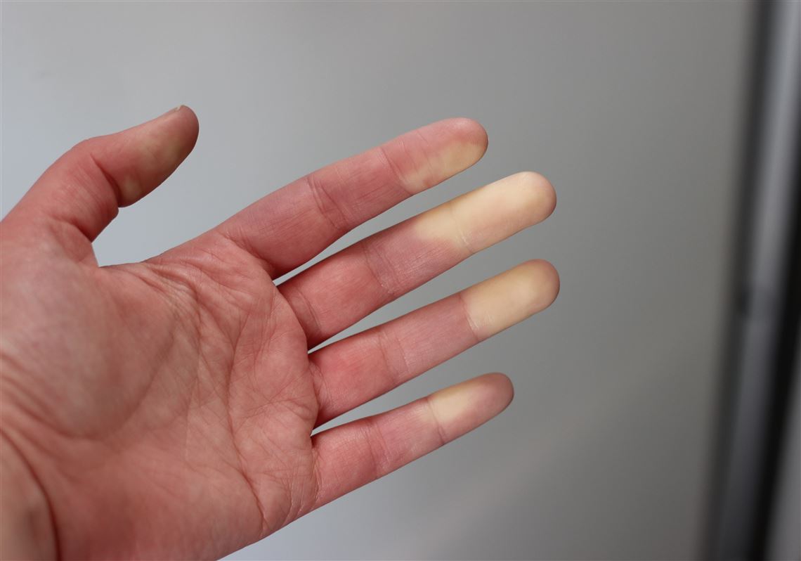 Understanding Raynaud's Phenomenon: Key Facts and Information