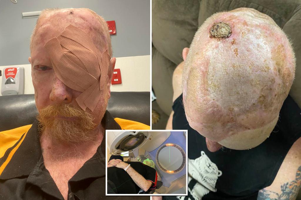 Featured image for "Former Lifeguard's Terrifying Cancer Battle Highlights Importance of Sun Protection"