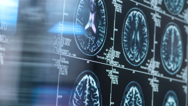 Lithium Shows Promise in Protecting and Reversing Brain Aging in Alzheimer’s