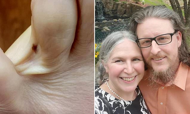 Toe Itch Leads to Skin Cancer Diagnosis for Woman
