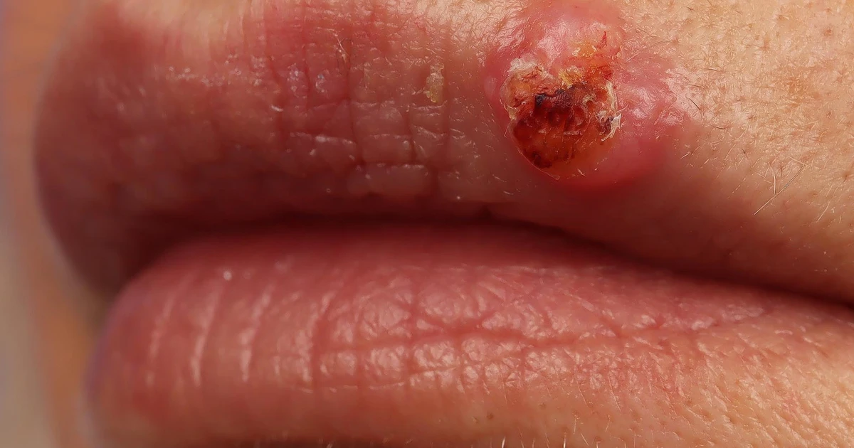 Featured image for Certain HPV Strain Linked to Skin Cancer