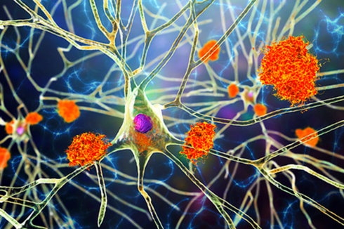 Featured image for Virus and Head Injury Link Offers New Insights into Alzheimer’s
