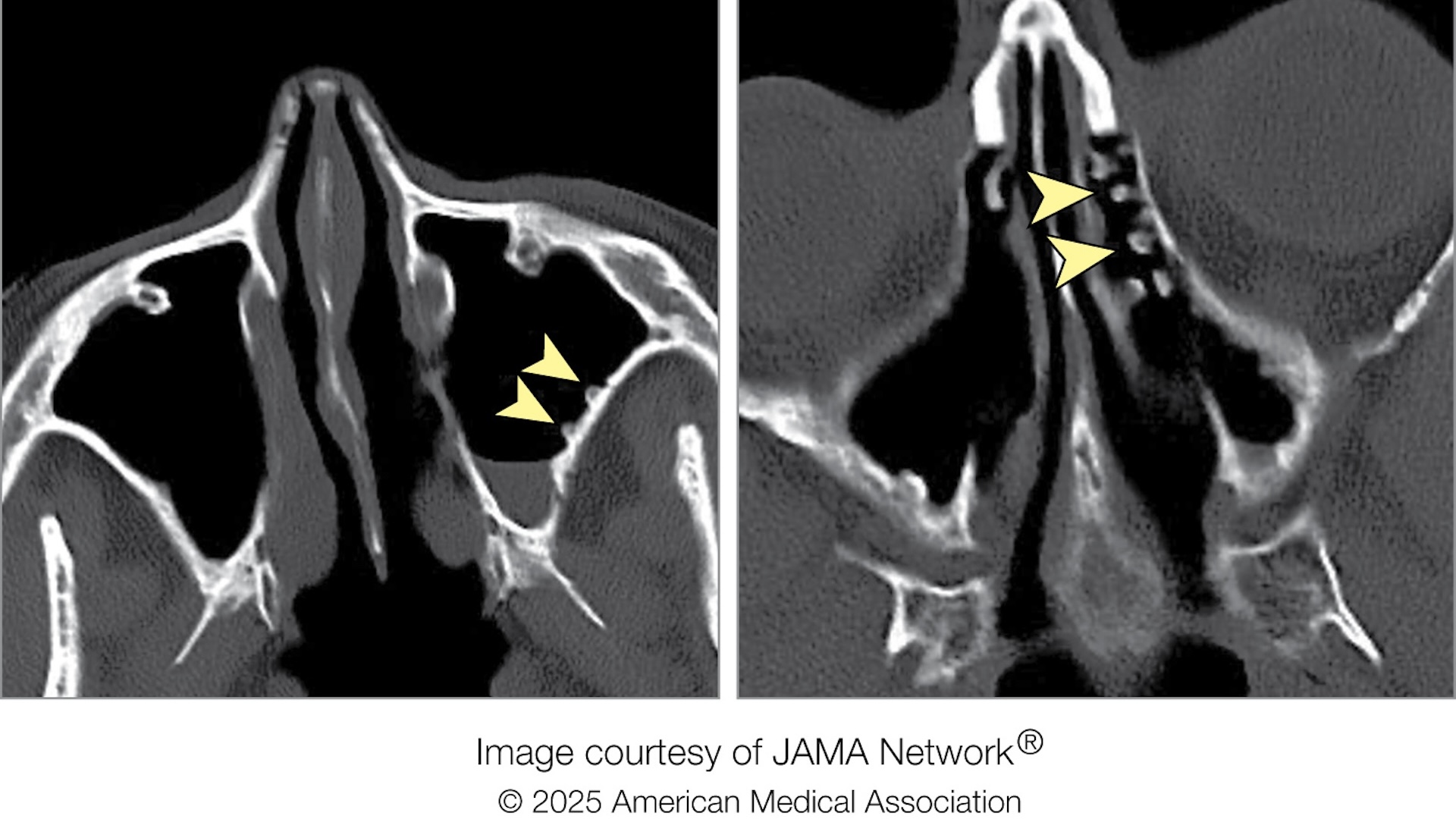 Featured image for Cold Water Rinses Cause Sinus 'Cobblestone' Growths in Woman