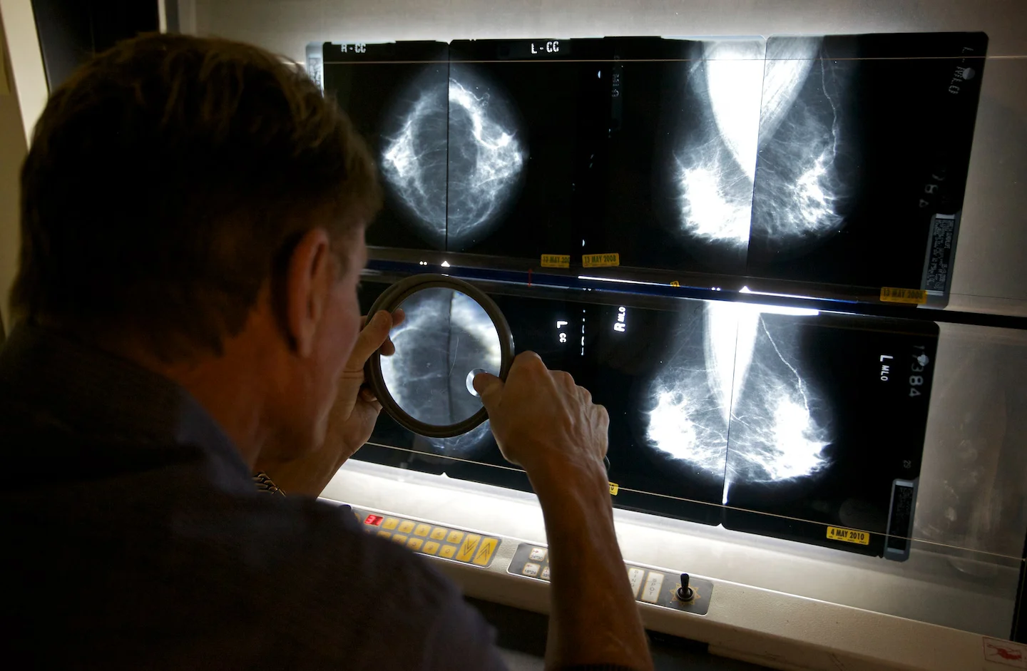 Rethinking Breast Cancer Screening Beyond Mammograms