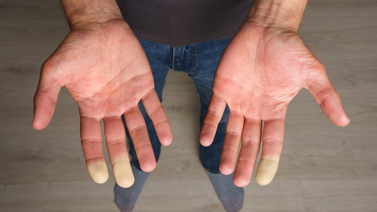 Featured image for "Fast Relief: Promising Remedies for Raynaud's Syndrome as Scientists Pursue a Cure"