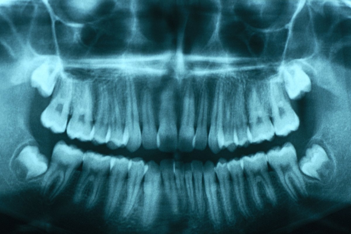 Featured image for Scientists Develop Drug to Regrow Missing Teeth