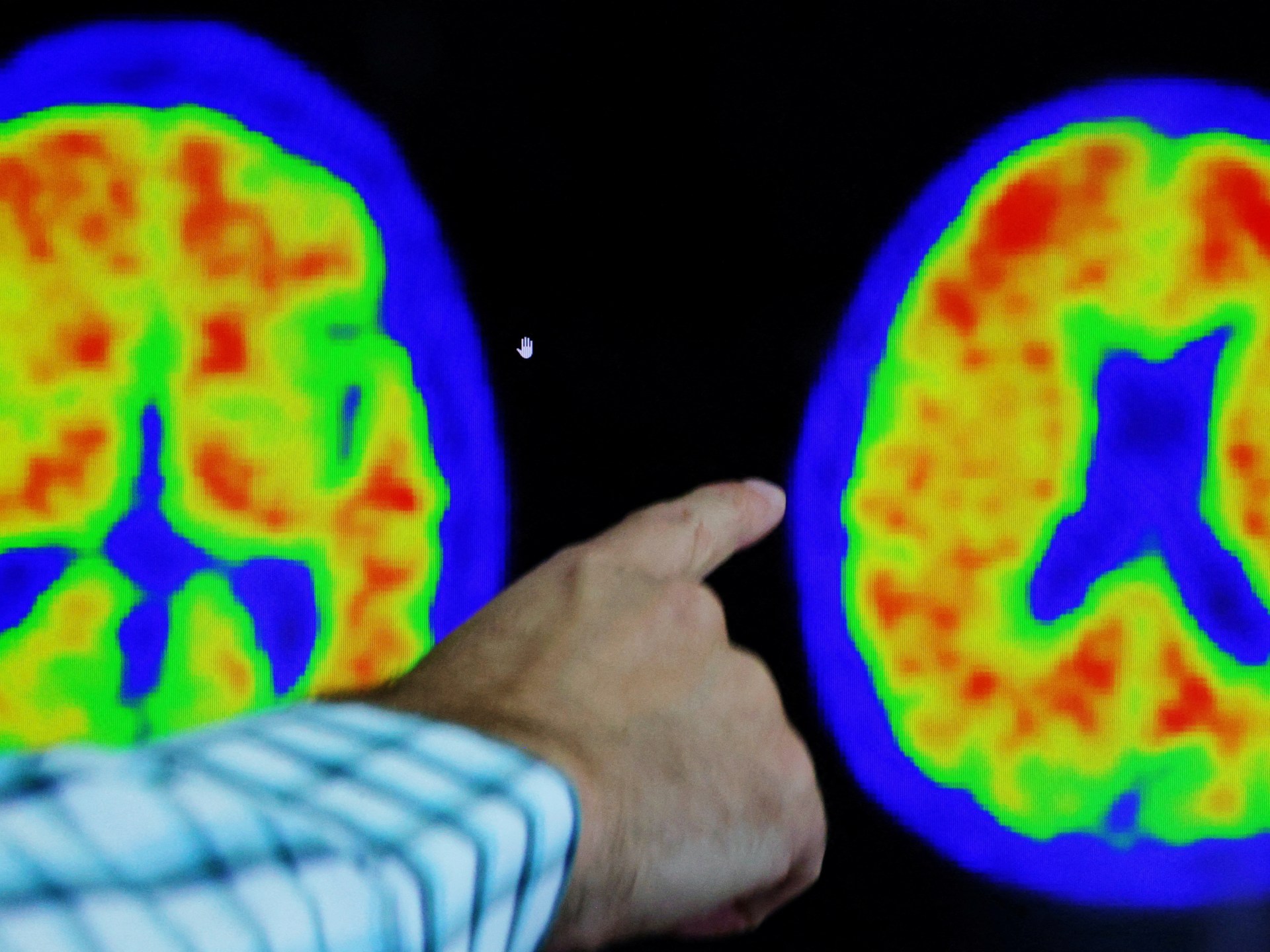 Donanemab: A Promising Drug for Alzheimer's Treatment