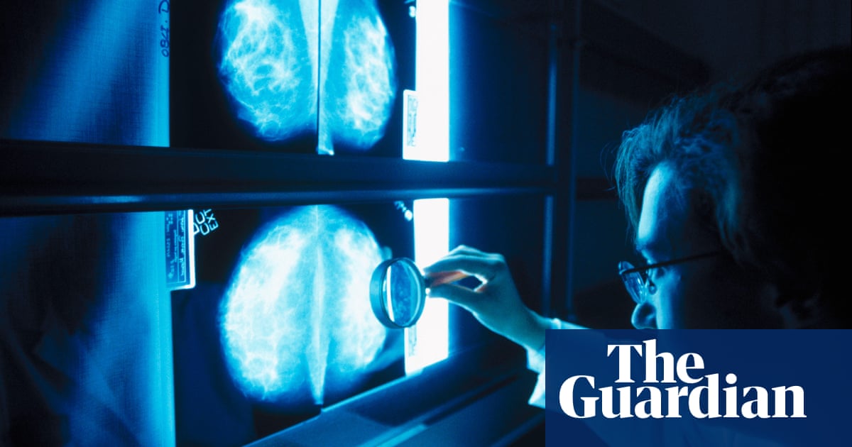 Featured image for Understanding the Importance of Breast Cancer Risk Assessment Scores