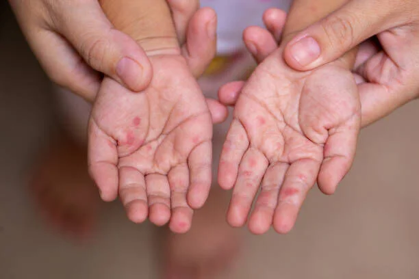 Featured image for Rising Hand, Foot, and Mouth Disease Cases Prompt Health Warnings