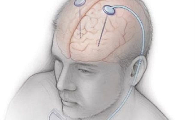 Featured image for "US Man Succumbs to Deadly Brain Disease Linked to Covid-19"