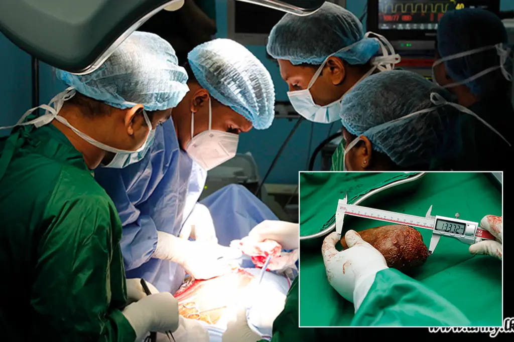 Featured image for Sri Lankan doctors remove record-breaking 1.8 pound kidney stone.