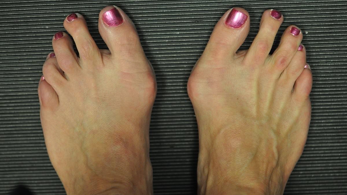 Featured image for "Say Goodbye to Bunions with This Clever Physical Therapy Trick"