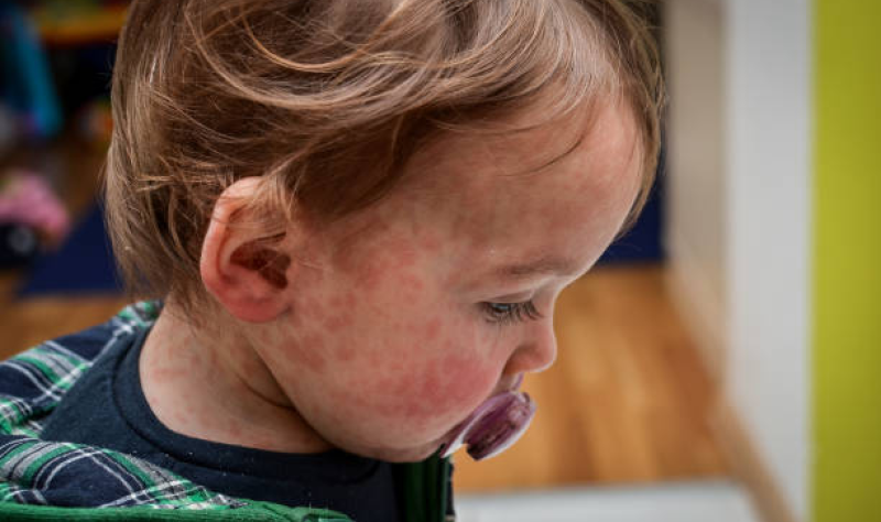 US Measles Outbreaks Highlight Urgent Need for Vaccination and Local Data