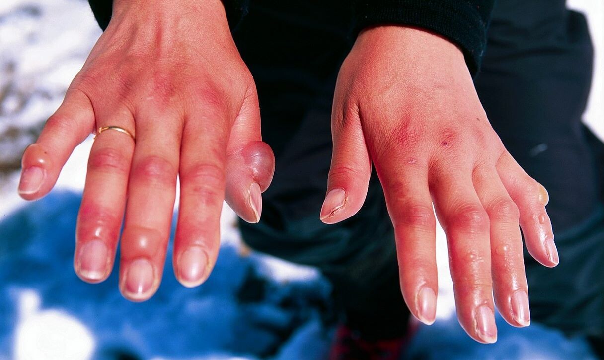 "FDA Approves First Medication to Prevent Frostbite Amputation"