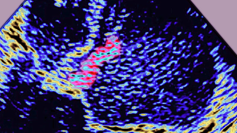 "Updated Guidelines for Infective Endocarditis Released by ESC"