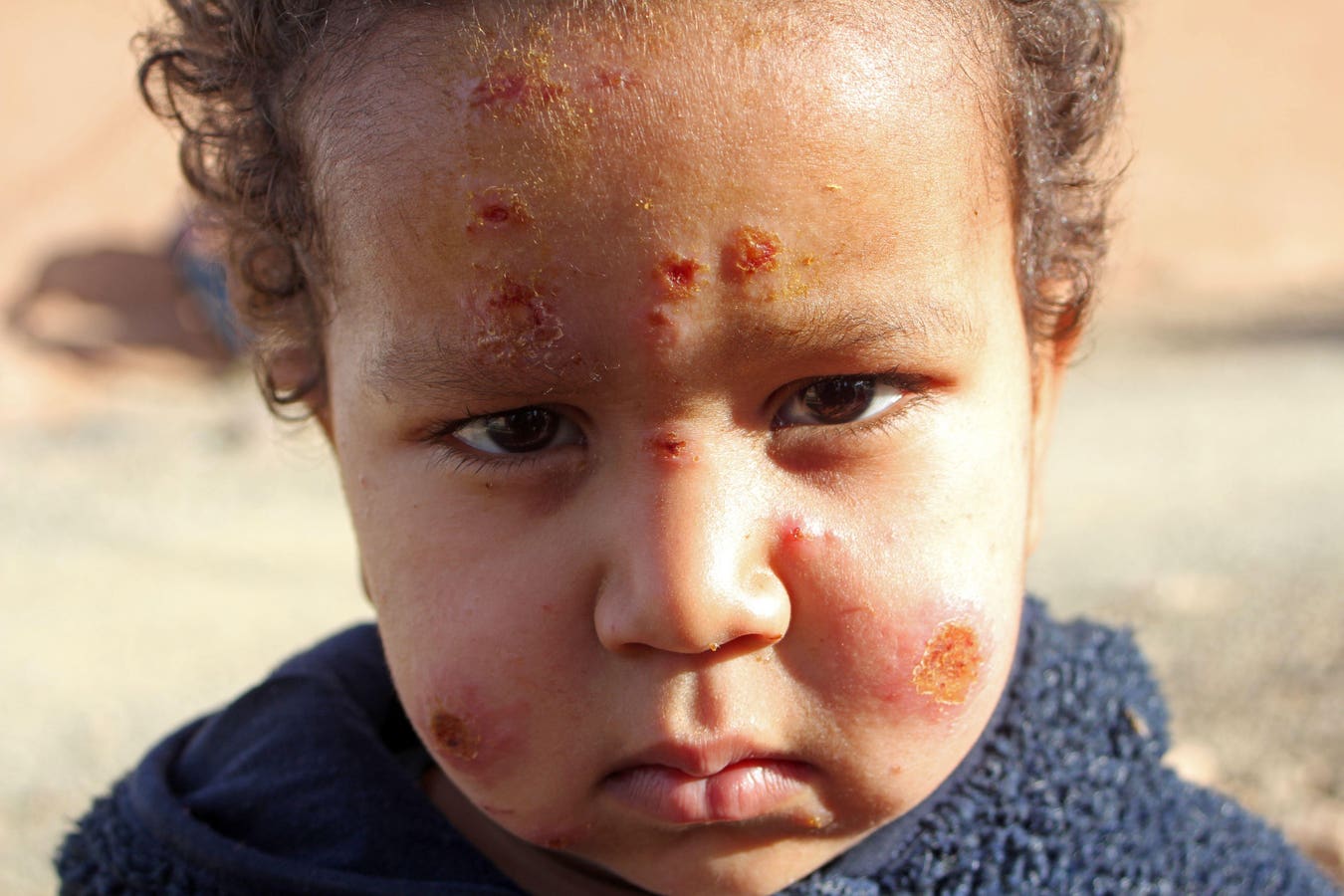 Featured image for The Endemic Spread of Flesh-Eating Parasitic Disease in the US