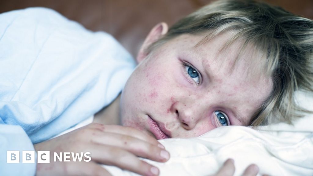 "Urgent Call for Vaccination as Measles Cases Skyrocket in Europe"