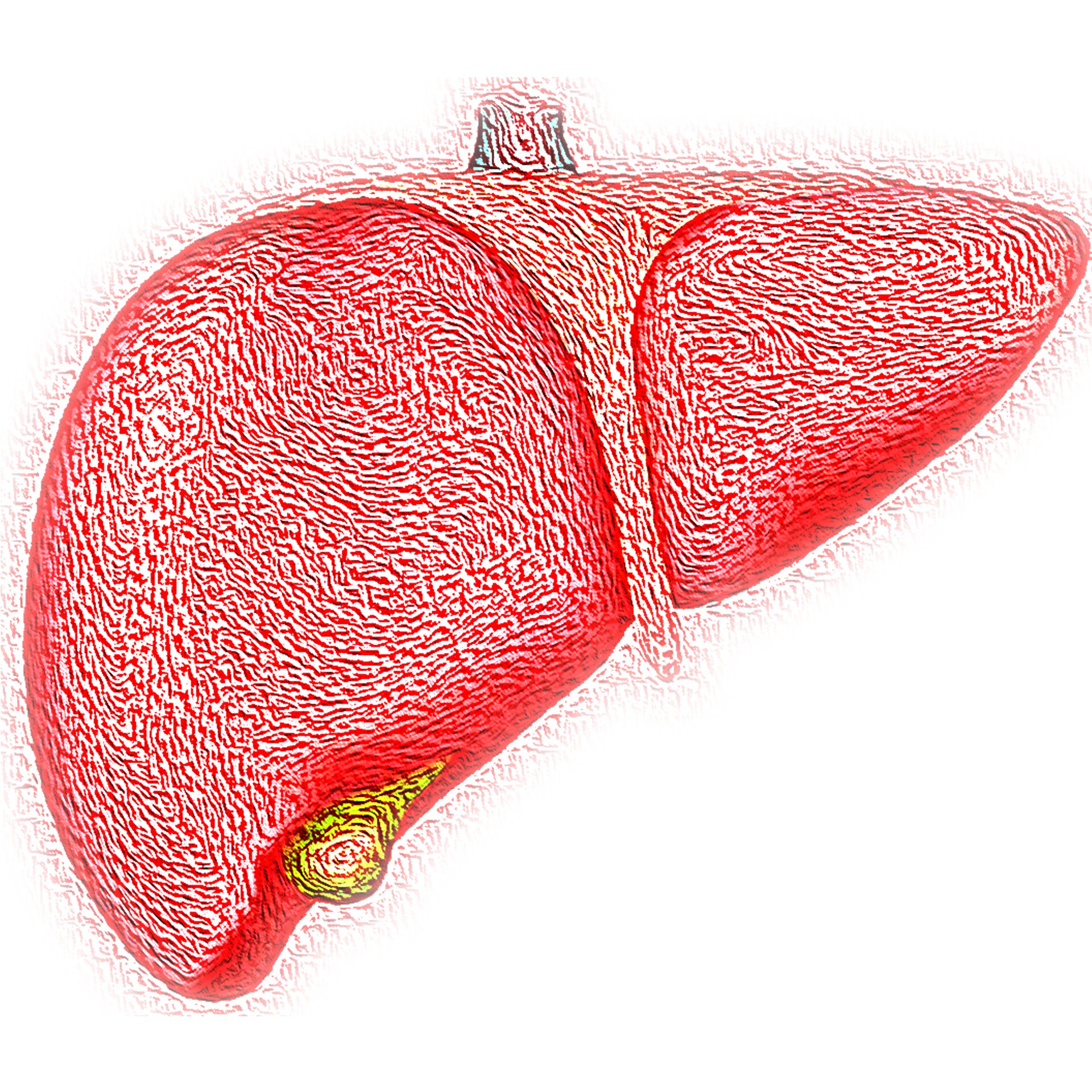 Featured image for Excessive Alcohol Consumption Impairs Liver Regeneration and Promotes Fatty Liver Disease