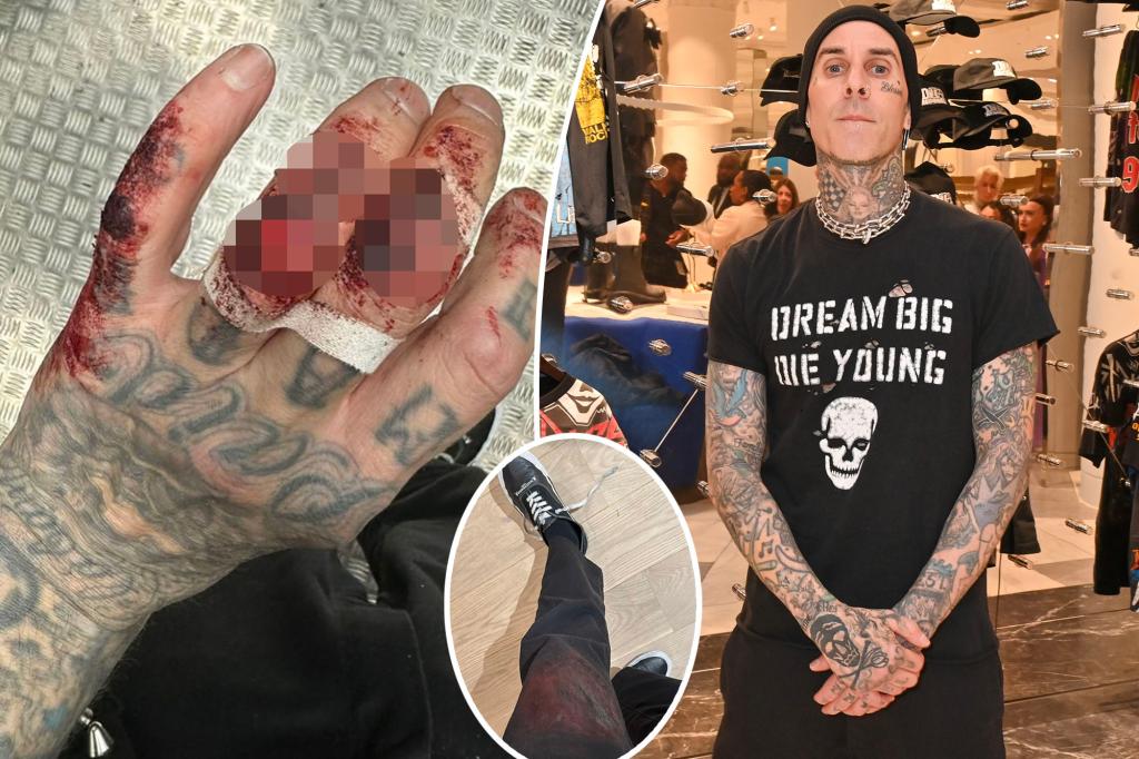 Featured image for Travis Barker's Gruesome Hand Injury Revealed After Blink-182 Concert