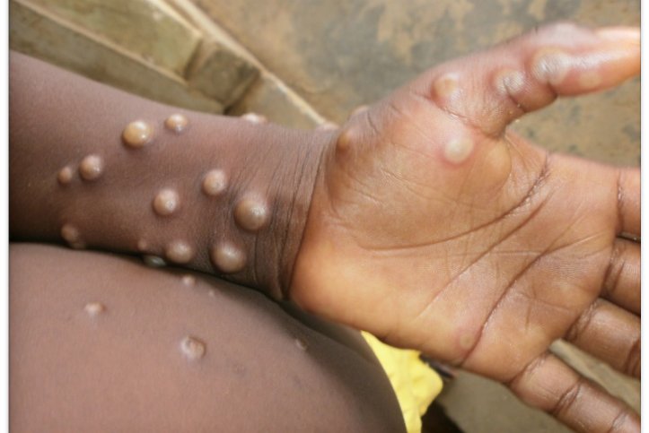"Rising Mpox Infections Prompt Urgent Vaccination Warnings"