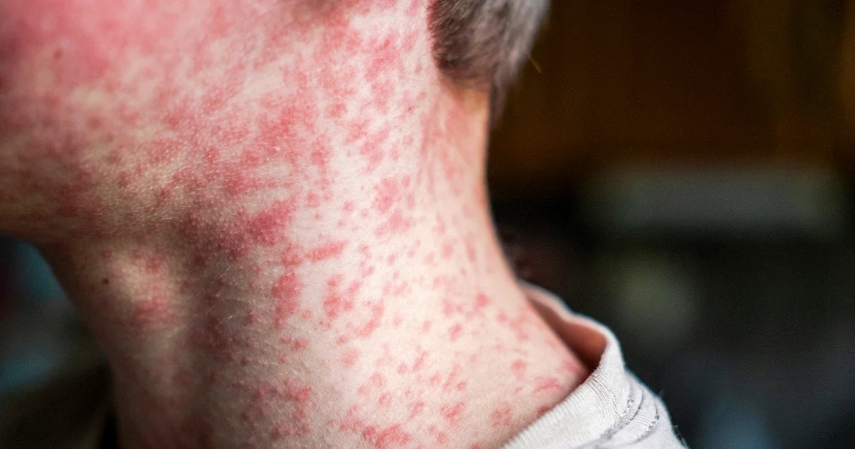 US Measles Cases Exceed 2,000, Threatening Elimination Goals