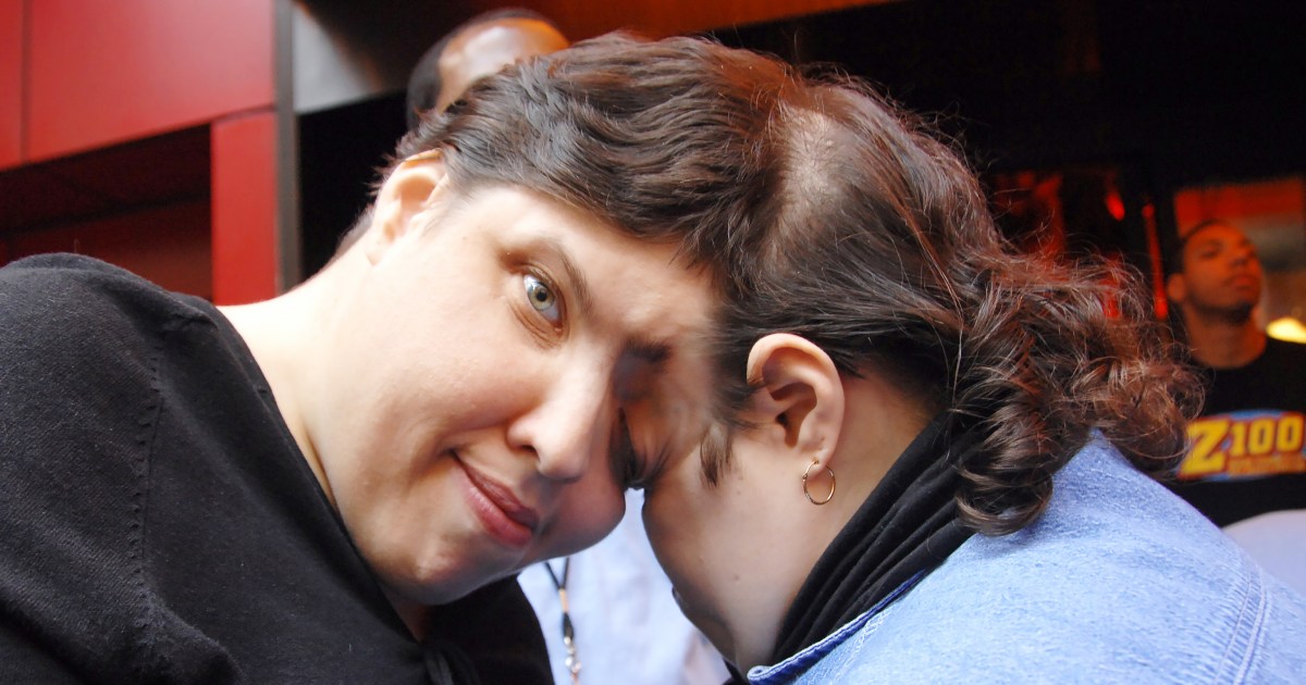 Featured image for "World's Oldest Conjoined Twins, Lori and George Schappell, Pass Away at 62"