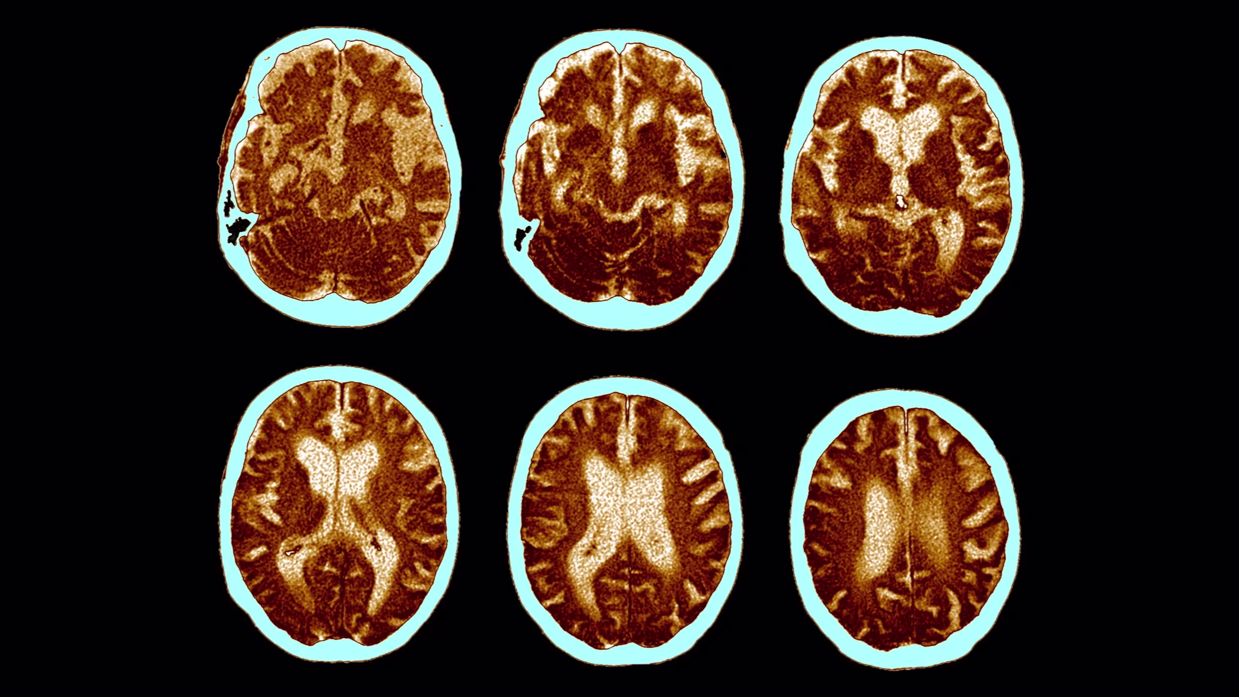 Can Obesity Drugs Offer Hope for Alzheimer's Treatment?