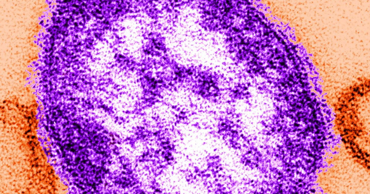 Featured image for Measles Outbreak: Second Case Confirmed in Washtenaw County with Exposure Locations Listed
