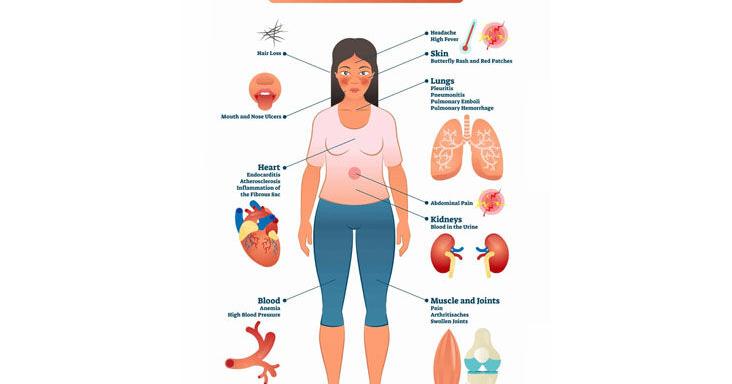 Featured image for Unraveling the Mystery: The X Chromosome's Role in Women's Higher Risk of Autoimmune Disease