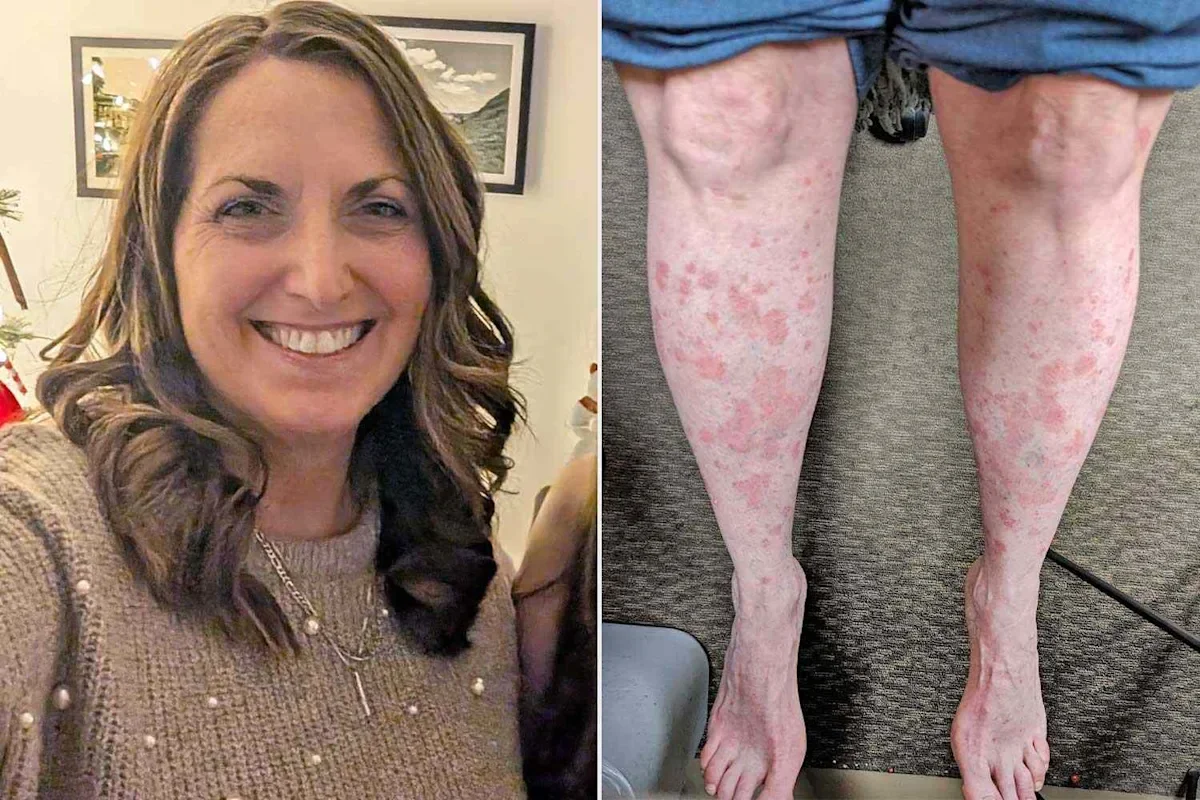 From Shame to Clear Skin: A Psoriasis Patient’s Breakthrough Trial