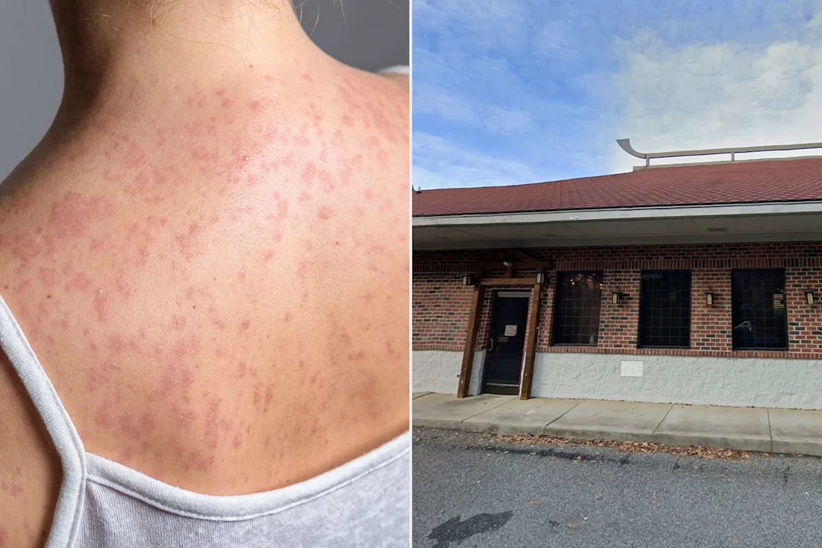 Featured image for Health Officials Warn of Measles Risk After Restaurant Visit in State