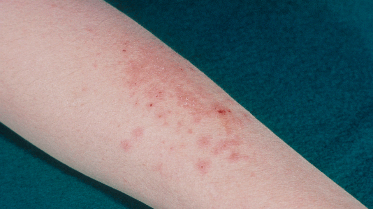 Featured image for First U.S. Case of Sexually Transmitted Ringworm Detected
