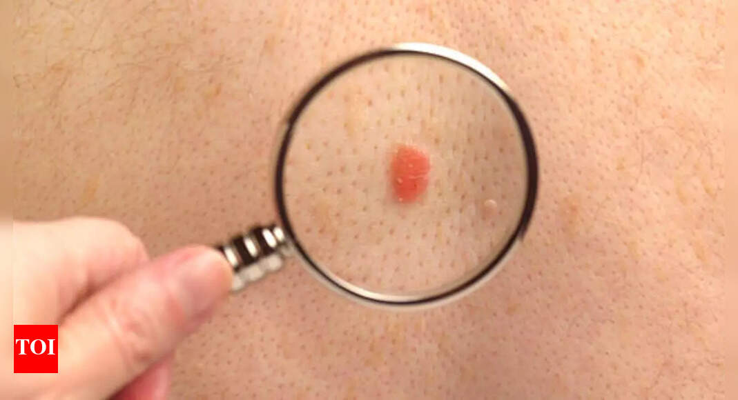 Featured image for Essential Tips for Recognizing and Preventing Skin Cancer