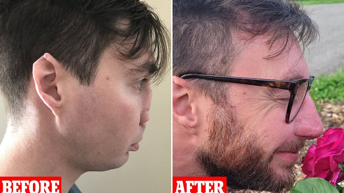 Featured image for "37-Year-Old Massachusetts Man's Remarkable Facial Transformation After Dog Attack Surgery"