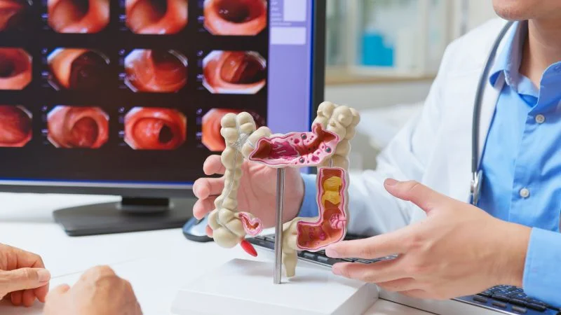 Early Detection of Colon Cancer Rises as Screening and Diet Awareness Increase